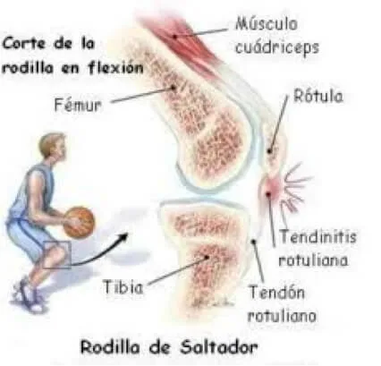 Centro Especializado en Ortopedia 13 10 rodilla saltador jpg
