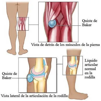 Clínica de geriatría 5 13 Quiste de baker jpg