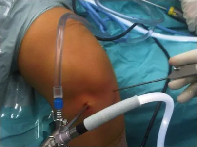Centro Especializado en Ortopedia 17 14 Artritis septica de la rodilla jpg