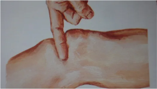 Centro Especializado en Ortopedia 18 15 Ruptura del tendon del cuadriceps jpg
