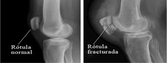 Centro Especializado en Ortopedia 19 16 Fractura de rotula jpg