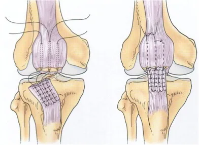 Centro Especializado en Ortopedia 20 17 Ruptura del tendon rotuliano jpg