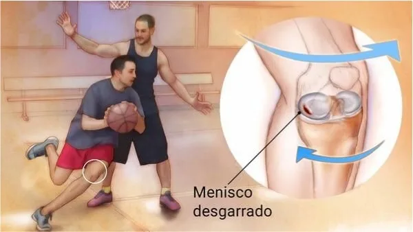 Centro Especializado en Ortopedia 5 2 Lesiones Meniscales jpg