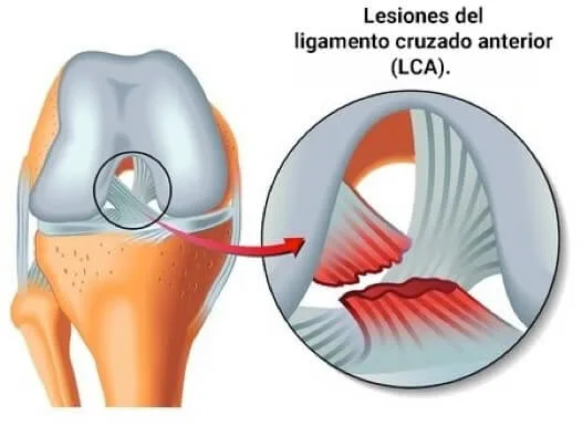 Centro Especializado en Ortopedia 6 3 Lesiones Meniscales jpg