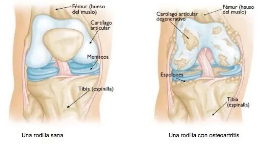 Centro Especializado en Ortopedia 8 5 Osteoartritis de la rodilla jpg