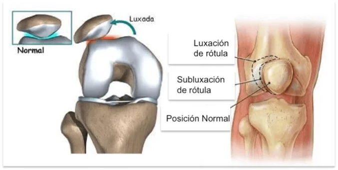 Centro Especializado en Ortopedia 9 6 Luxacion de rotula jpg