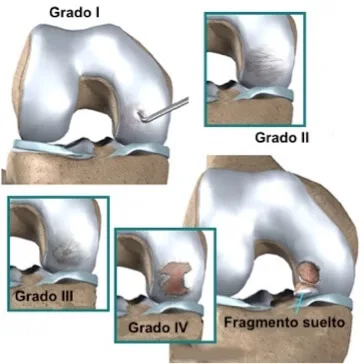 Centro Especializado en Ortopedia 12 9 Osteocondritis jpg