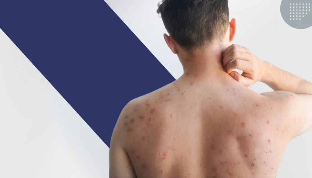 SARAMPIÓN Prevención, Diagnóstico, Vacunaciónen Niños y Adultos. 2 hero sarampion